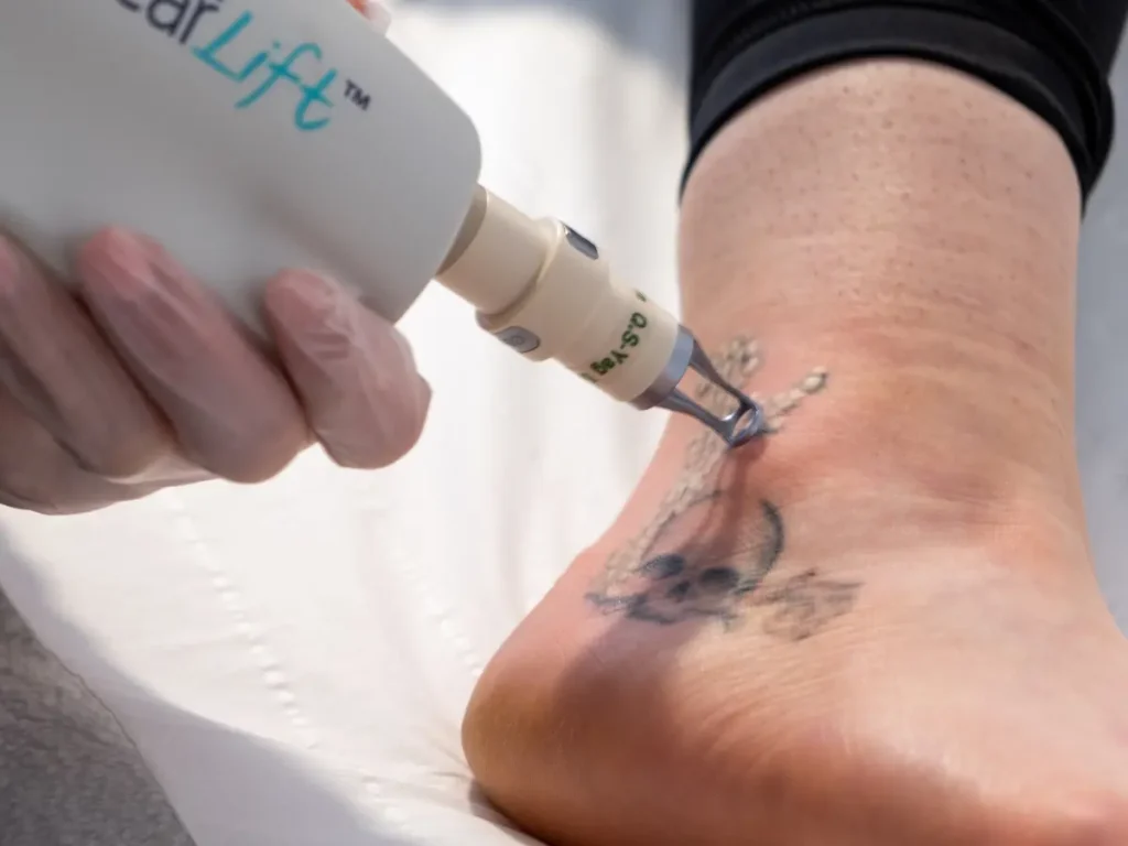 Affordable tattoo removal clinics in Surat