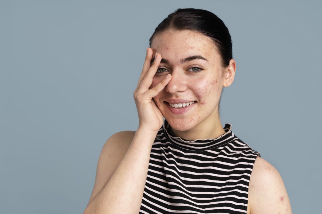 Best Acne Scar treatment Surat